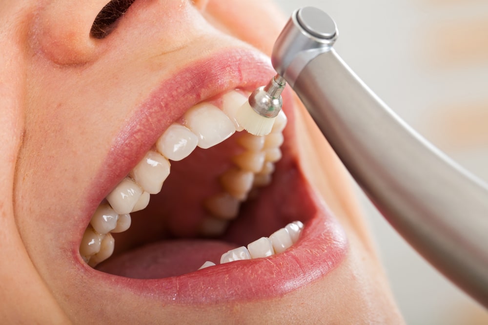 Reasons why dental cleaning is important